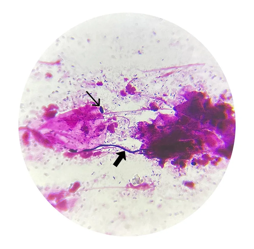 candidiase