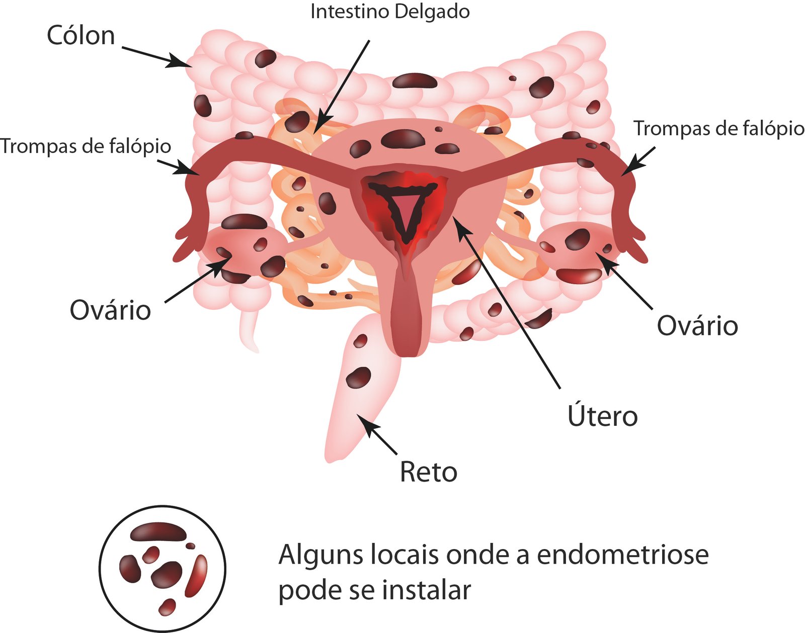 endometriose