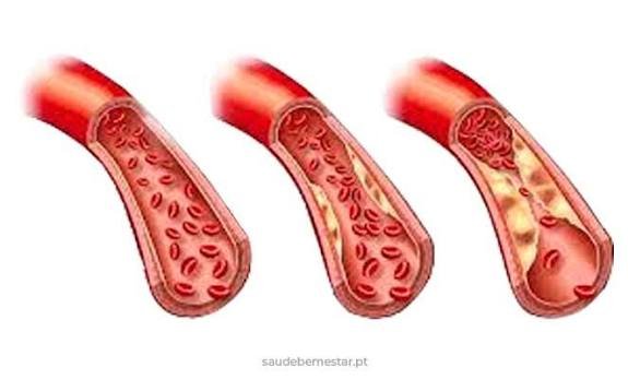 Referências científicas Este artigo foi elaborado com base em diretrizes e publicações de instituições reconhecidas internacionalmente: Sociedade Brasileira de Cardiologia (SBC) Diretriz Brasileira de Dislipidemias e Prevenção da Aterosclerose https://www.portal.cardiol.br American Heart Association (AHA) Cholesterol Management Guidelines https://www.heart.org European Society of Cardiology (ESC) ESC Guidelines for the Management of Dyslipidaemias https://www.escardio.org National Lipid Association (NLA) Clinical Practice Recommendations https://www.lipid.org National Heart, Lung, and Blood Institute (NHLBI) High Blood Cholesterol https://www.nhlbi.nih.gov Centers for Disease Control and Prevention (CDC) About Cholesterol https://www.cdc.gov/cholesterol MedlinePlus – U.S. National Library of Medicine Cholesterol https://medlineplus.gov/cholesterol.html triglicerideos